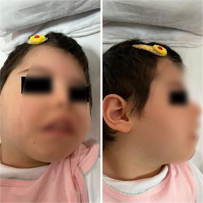 Case report: Diagnosis of a patient with Sifrim–Hitz–Weiss syndrome, development and epileptic encephalopathy-14, and medium chain acyl-CoA dehydrogenase deficiency